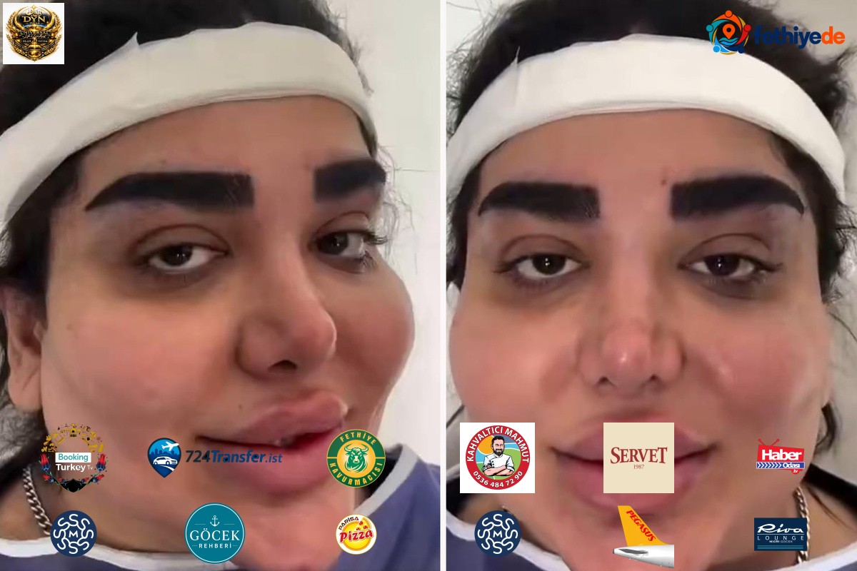 Yüzüne estetik yaptırdı ama boşa