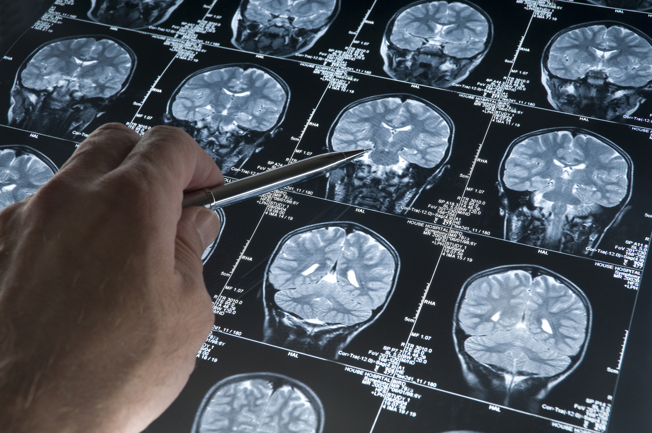 Alzheimer'da gençlik proteini keşfi